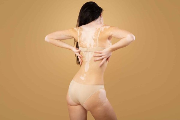 Comment se débarrasser des taches brunes sur la peau ?